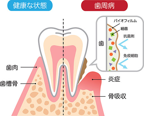歯周病は進行に合わせての治療が重要